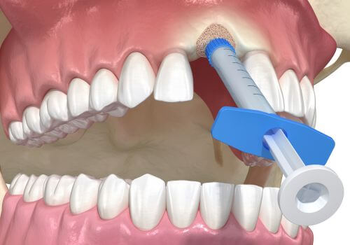 Illistration of bone graft after extraction.