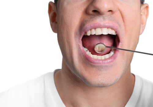 Oral cancer screening, male patient with dental mirror in his mouth.