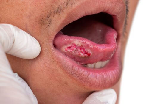 Squamous cell carcinoma of tongue. Oral cancer found during dental screening.
