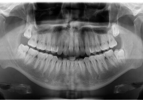 Panoramix x-ray of dental client.