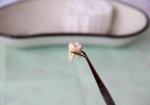 Wisdom tooth held by dental tools following wisdom tooth removal