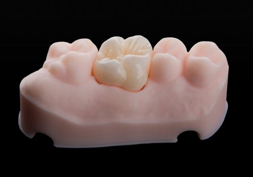 Model of a single dental crown after a root canal