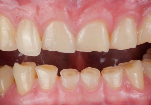 Uneven tooth wear caused by poor bite alignment