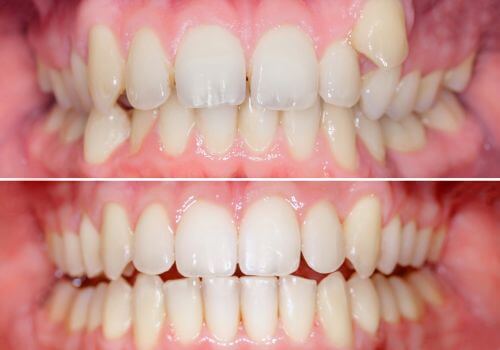 Smile makeover correcting bite and crooked teeth