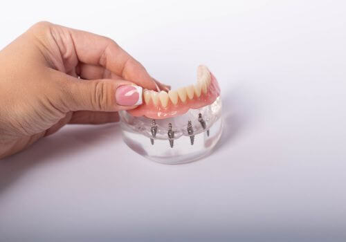Dental implants on mouth mold.