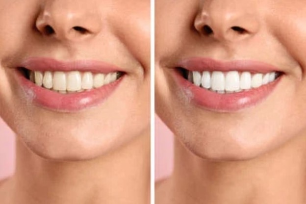 Whitening