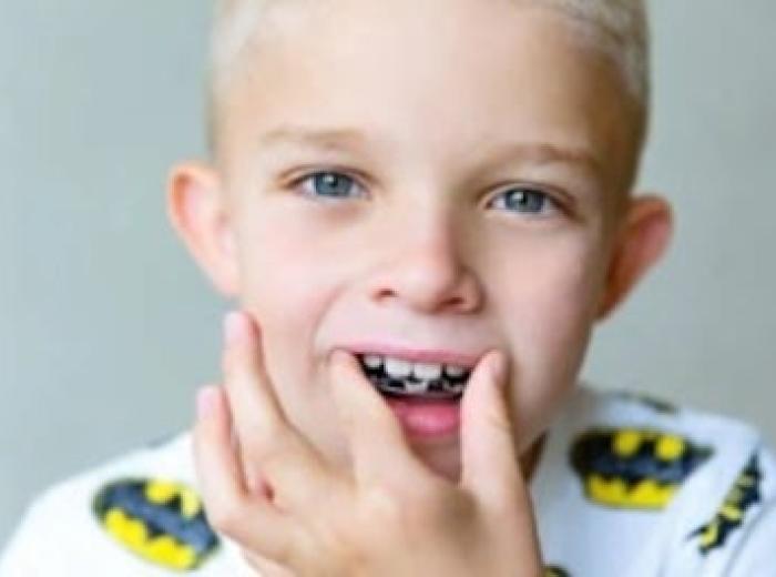 Child Orthodontics: Straightening Teeth for a Healthier Smile