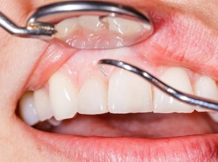 Types of Teeth Cleaning: A Breakdown of Different Options Available