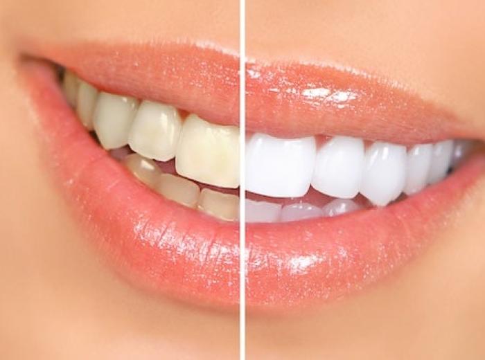 Difference Between Professional Teeth Whitening & Home Teeth Whitening Kit