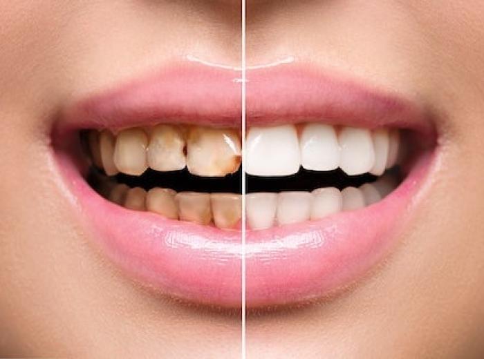 Caring for Restored Smiles: Tips for Long-lasting Dental Work