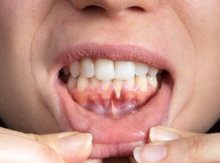Gum Recession: Causes, Treatment, and Prevention