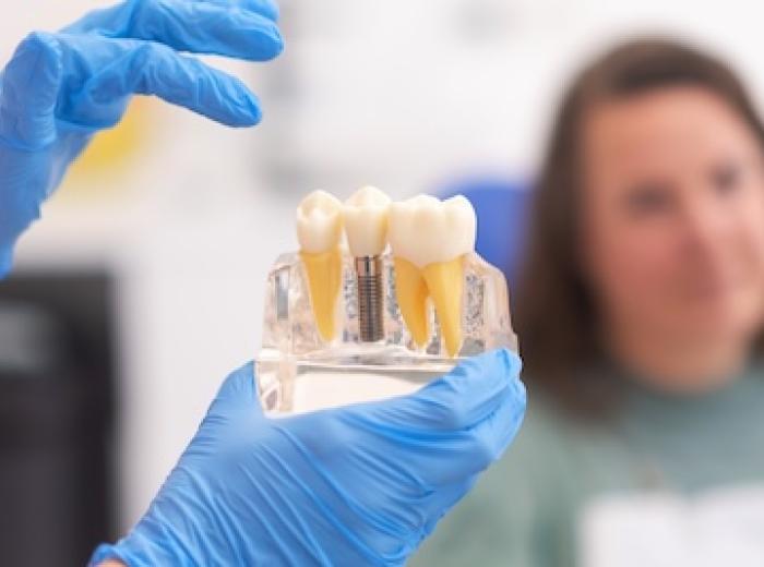 What Are Dental Implants & What You Need to Know