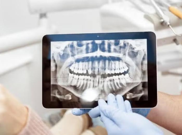 Are Dental X-Rays Safe? Debunking Myths and Addressing Concerns