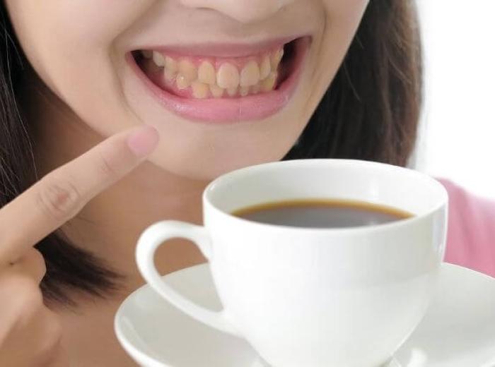 Common Causes of Tooth Discoloration: Addressing Stains for a Whiter Smile