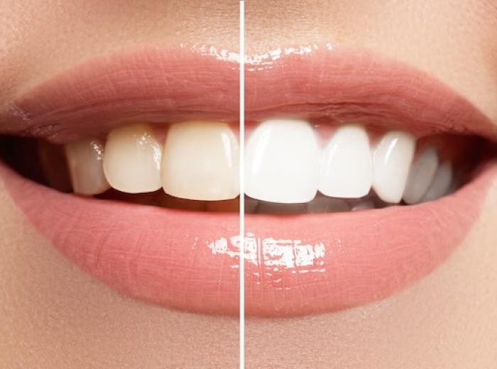 The 3 Best Cosmetic Dental Procedures for a White Smile