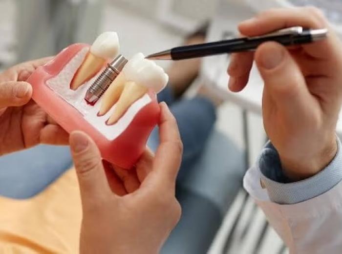 Dentures vs. Implants: Exploring Options for Full Arch Restoration