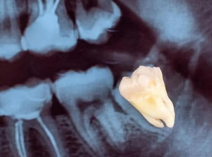Everything You Need to Know About Wisdom Teeth Removal: Signs, Procedure, and Recovery