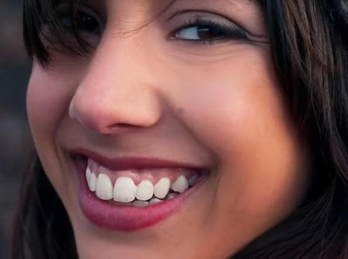 Gummy Smile Treatment: Everything You Need to Know