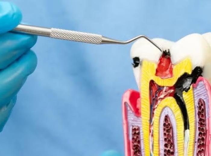 Root Canal Treatment FAQs: Common Patient Concerns and Clear Answers