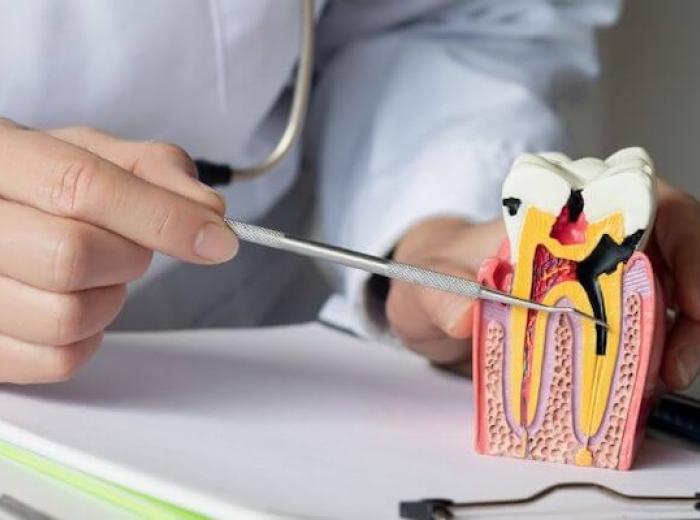 What to Expect During a Root Canal