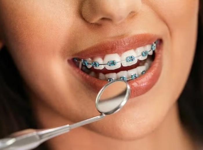 Your Guide to a Perfect Smile with Traditional Braces