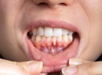 Gum Recession: Causes, Treatment, and Prevention