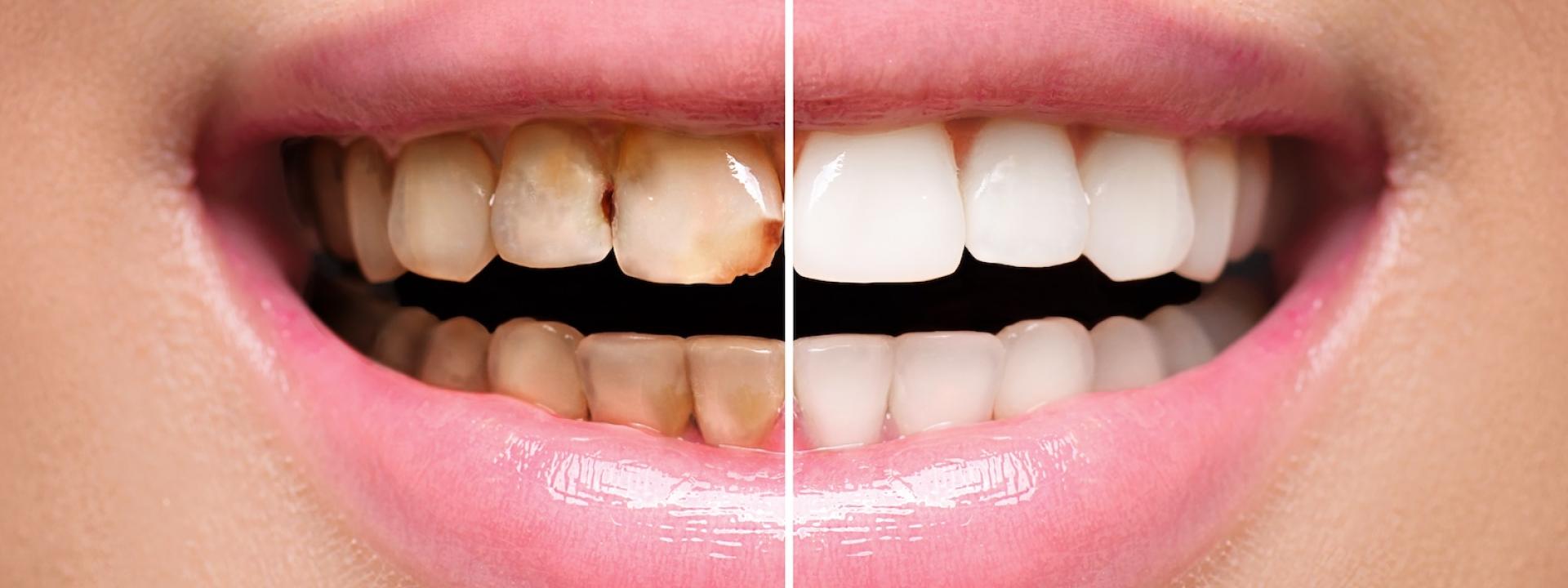 Caring for restored smiles