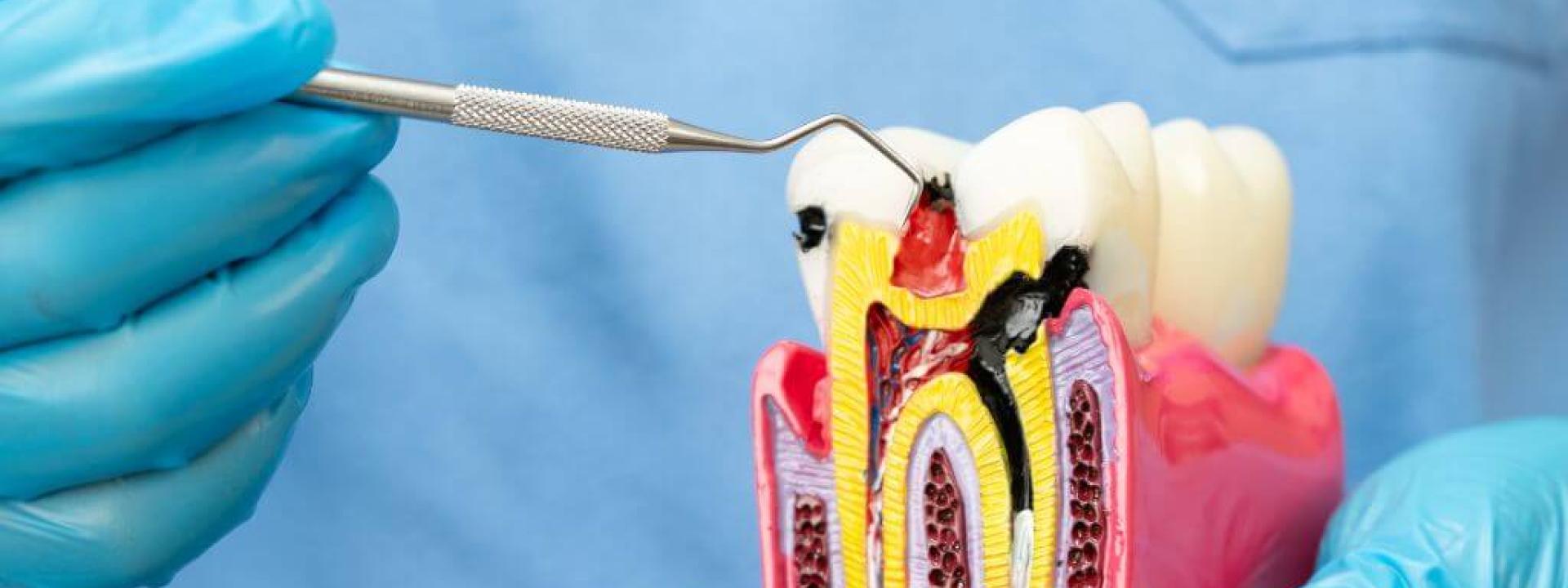Dentist holding root canal education model