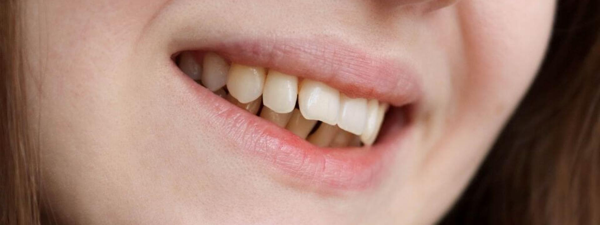 Signs You Need a Bite Adjustment and How Your Dentist Can Help Woman with malocclusion bite alignment issues